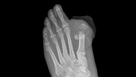 Studies Link Invokana to Diabetic Ketoacidosis, Toe Amputations