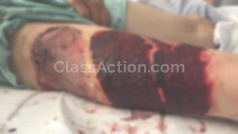 Man Sues Samsung After Exploding Galaxy S7 Edge Causes 3rd Degree Burns