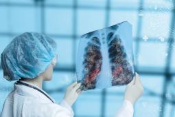 Mesothelioma Settlement